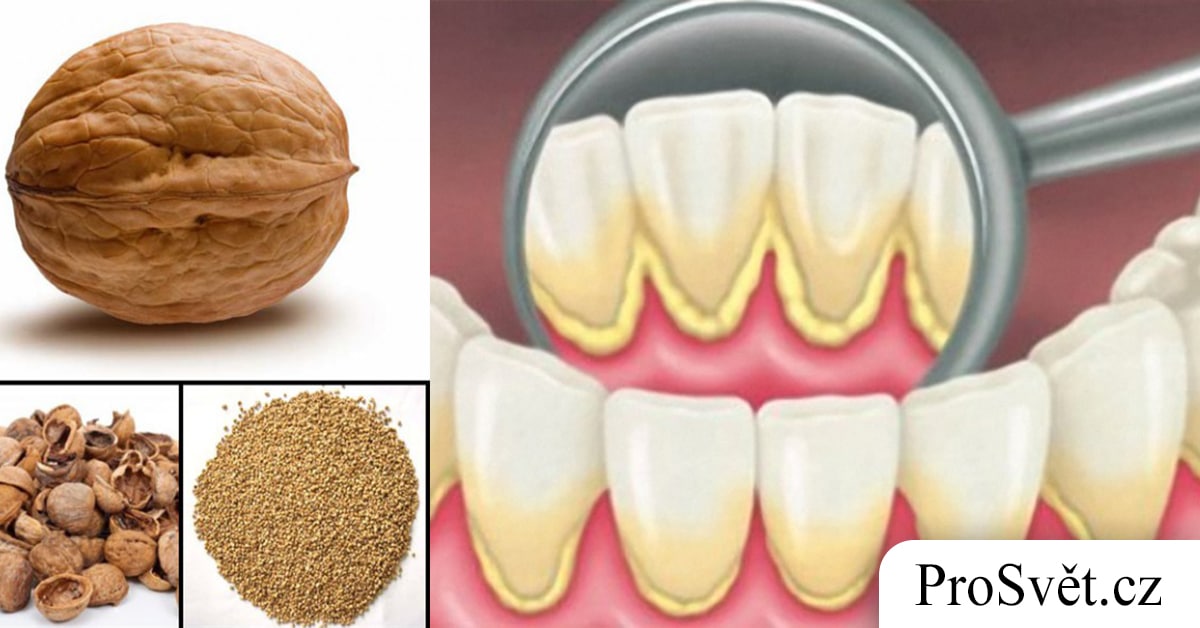 5 jednoduchých tipů, jak se úspěšně zbavit zubního plaku