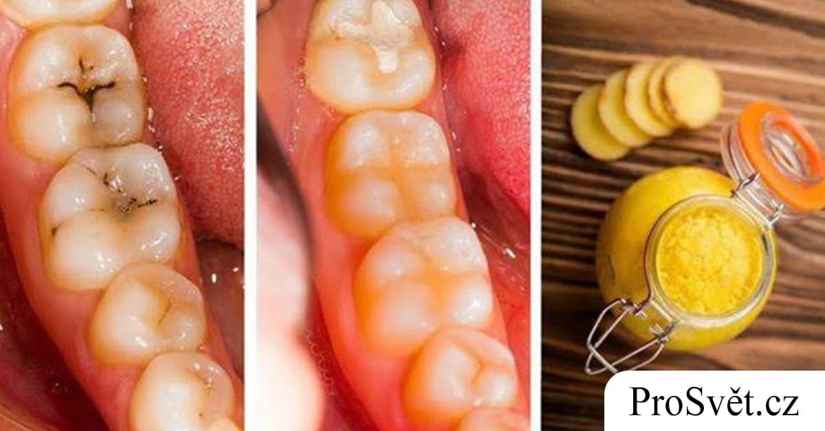 Ověřené domácí tipy, jak se zbavit zubních kazů a bolesti zubů!