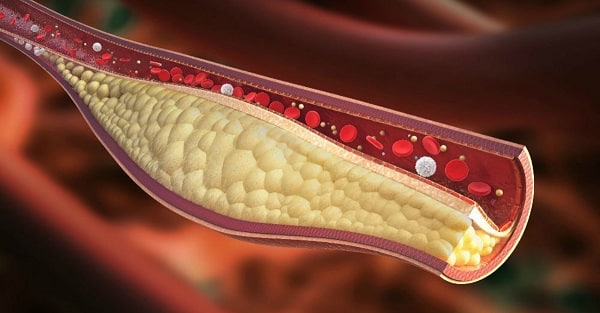 Dluho mě trápil vysoký cholesterol a doktor mě varoval! Jen jeden šálek tohoto nápoje mi pomohl dostat cholesterol do těch správných čísel!