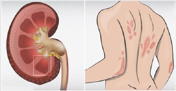 Pokud jsou vaše ledviny v nebezpečí, tělo vám ukáže těchto 7 znamení !