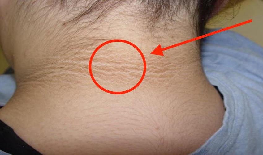 Má vaše dítě na zadní straně krku tyto hnědé skvrny, může mu hrozit nebezpečí.