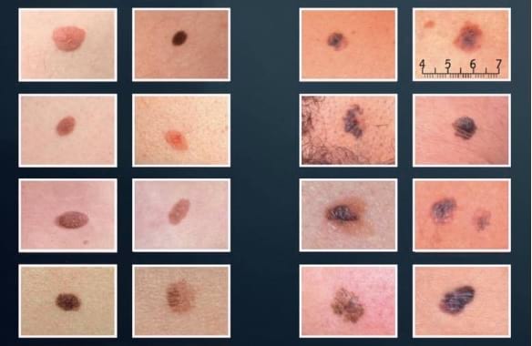 Pomocí těchto příznaků můžete snadno rozpoznat potenciální rakovinu kůže.