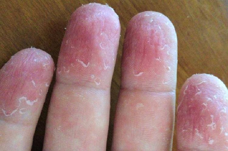 Loupající se kůže na rukách bude minulostí s použitím těchto přírodních metod, říká lekář