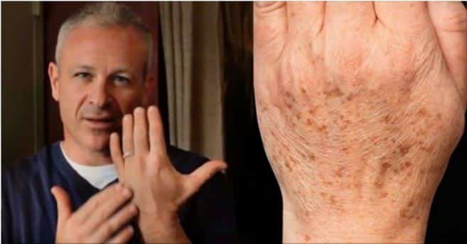 Americký lékař radí všem svým pacientům: jak rychle odstranit věkové skvrny na kůži. Pouze 2 ingredience!