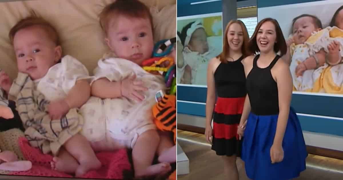 Ženě se narodila srostlá dvojčata k sobě: Trvalo 7 měsíců, než se rozhodli je oddělit