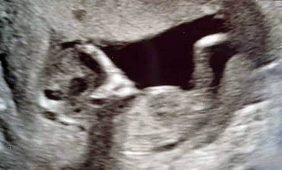 Mimozemšťan na ultrazvuku těhotné dívky