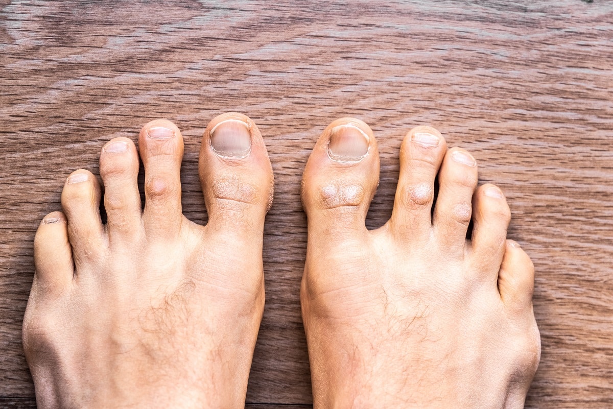 Jak nejlépe vyléčit plíseň nohou bez návštěvy lékaře?