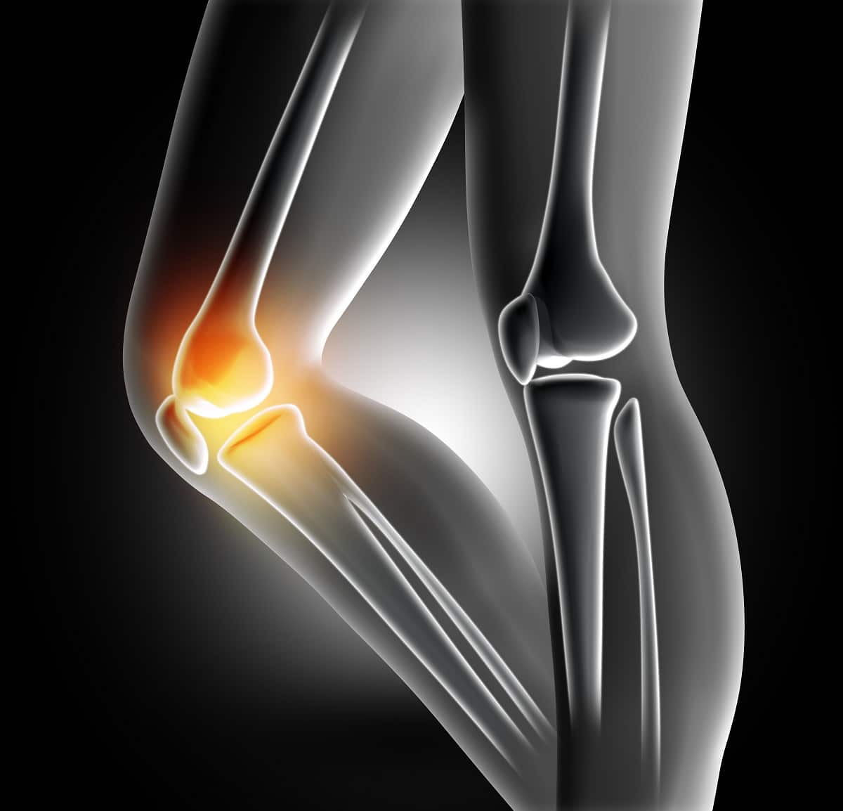Zbavte se bolesti kolene rychle bez použití chemie
