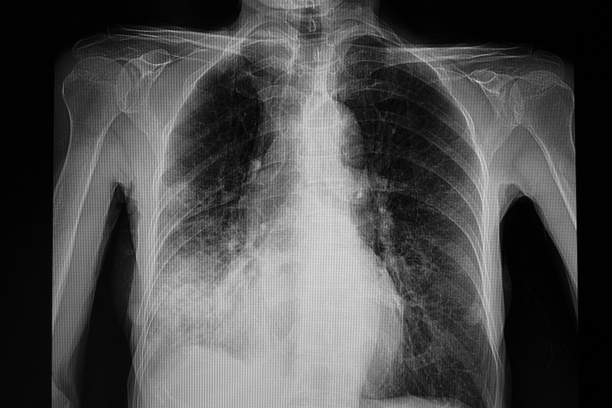 Jaké jsou hlavní příznaky zápalu plic? Nepodceňte je a včas vyhledejte lékaře