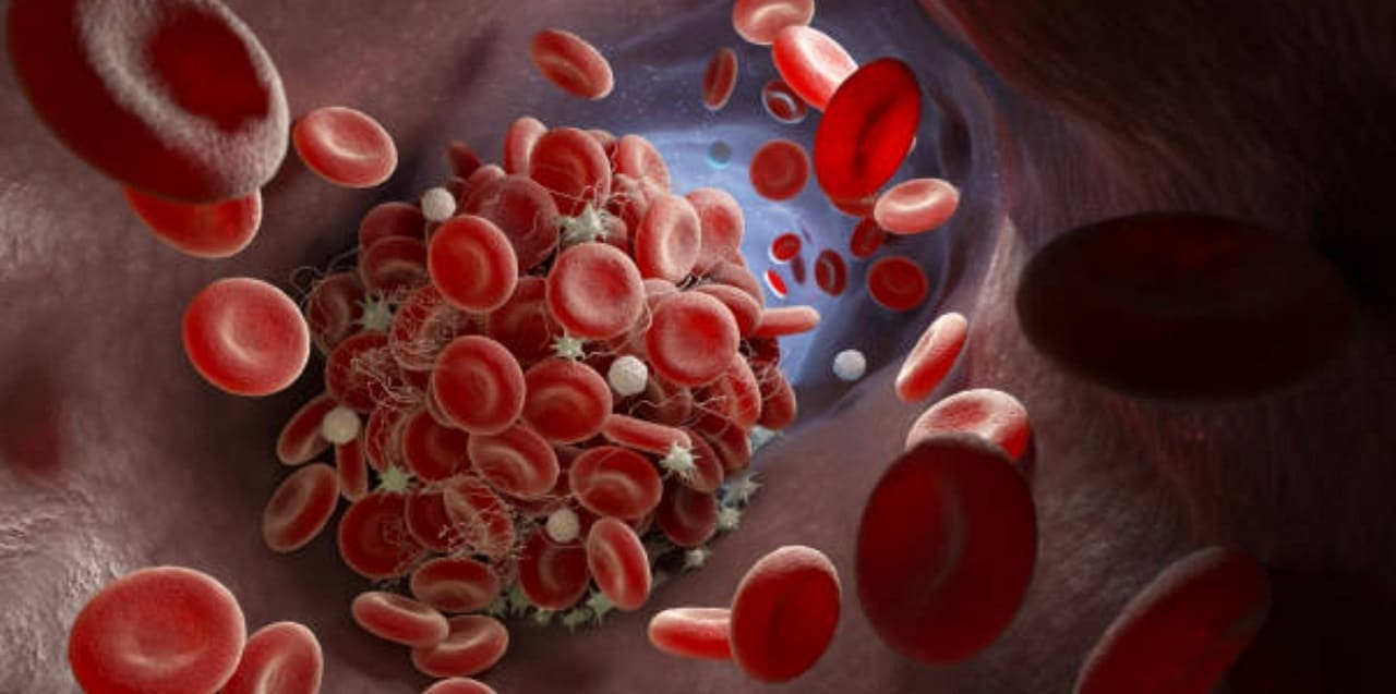 6 příznaků krevní sraženiny, které musíte znát!