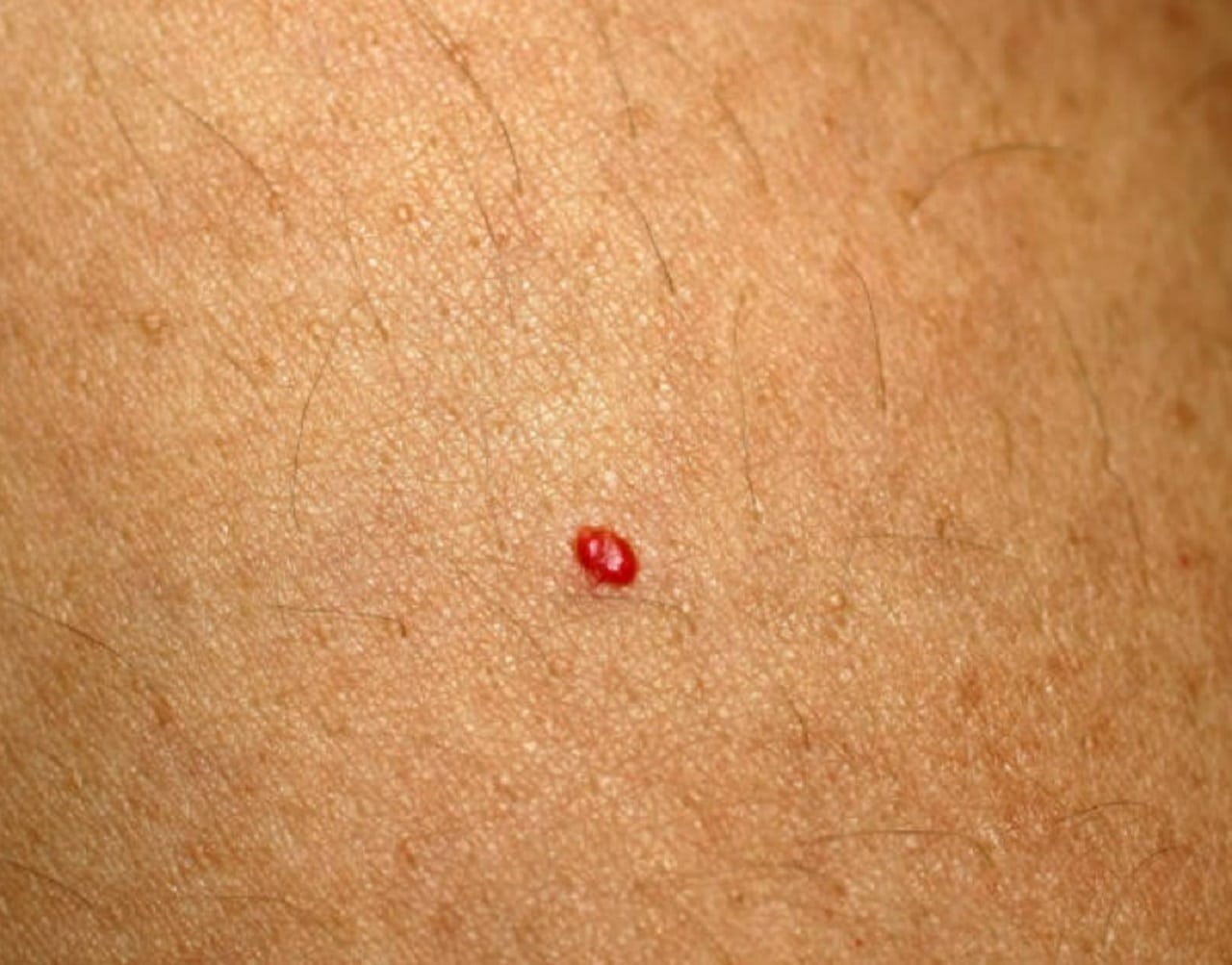 Co znamenají červené pupínky na kůži?