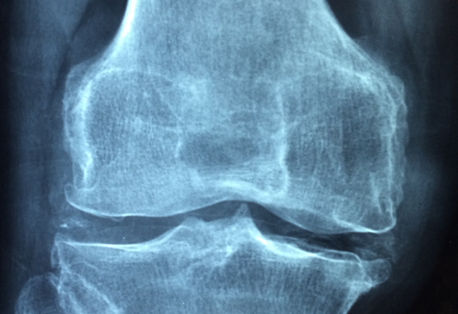 Poznejte osteoporózu včas a myslete na dobrou prevenci