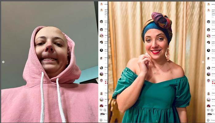 Velká bojovnice Anna Slováčková: Sdílí svůj drsný boj s rakovinou na sociálních sítích. Oholená hlava bez vlasů a vtipný popisek